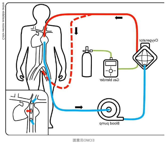 向死神要生命的ECMO：重症监护病房里的终极武器